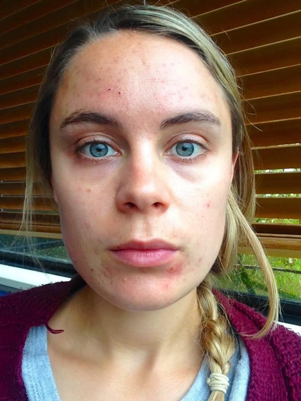 Tamika before — struggling with cystic acne in her early twenties